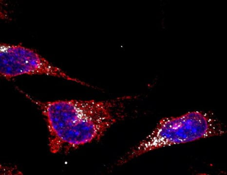 Insights from a rare genetic disease may help treat multiple myeloma Insights from a rare genetic disease may help treat multiple myeloma